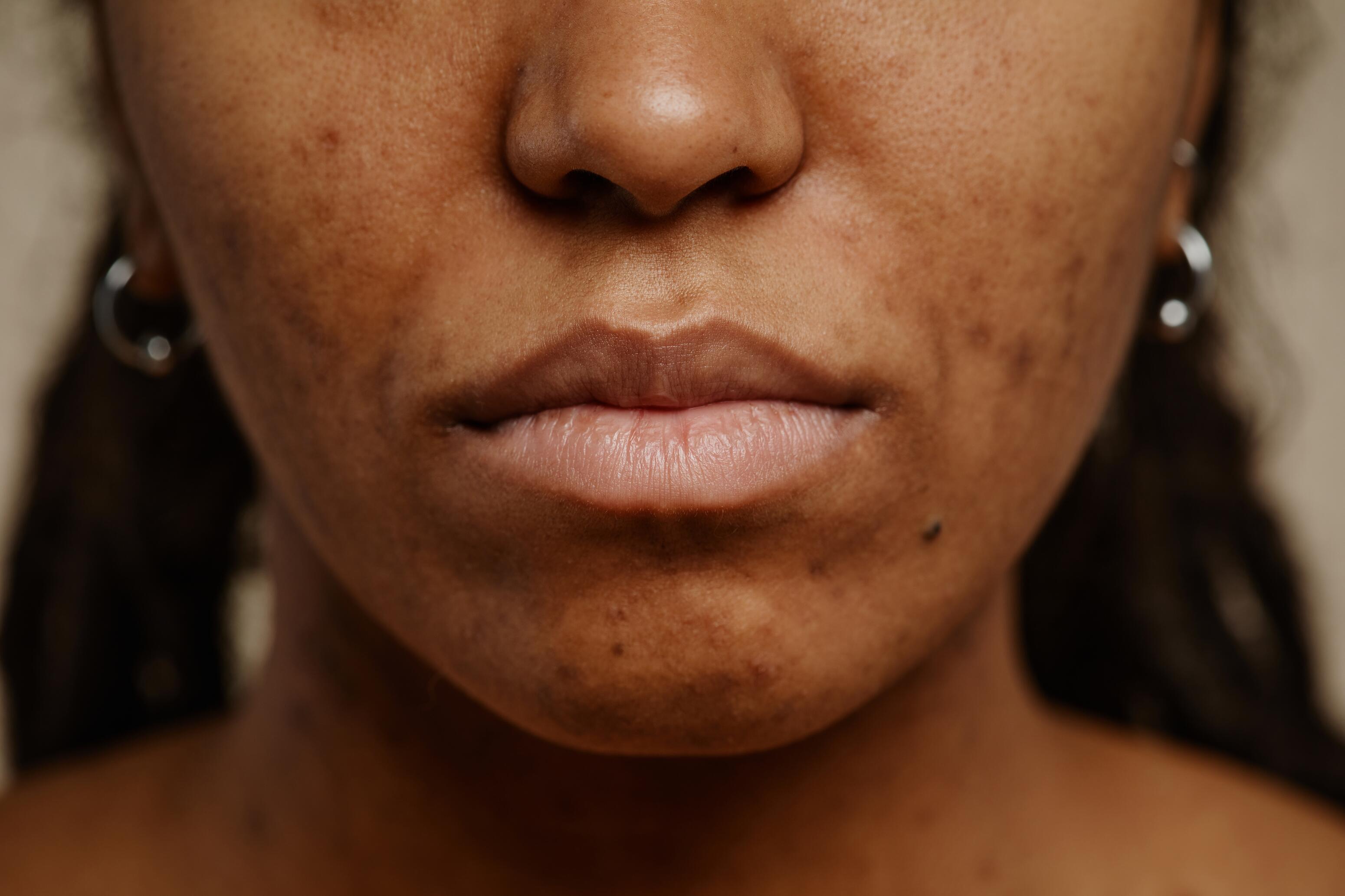 Acne scars with hyperpigmentation